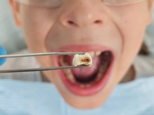 Best Emergency Treatment for Oral Infections in Hoffman Estates, IL